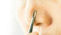 毛穴の黒ずみ・皮脂分泌を徹底解説｜効果的なケア方法と治療薬イソトレチノイン
