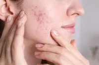 大人ニキビ原因と治し方|症状別ケアとイソトレチノインの効果