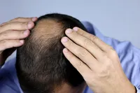 薄毛は早めの対策が重要!原因・改善方法とオンライン診療のすすめ