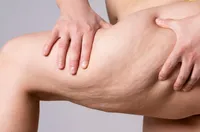 夏の露出で気になるセルライト|定義・原因・改善方法完全ガイド