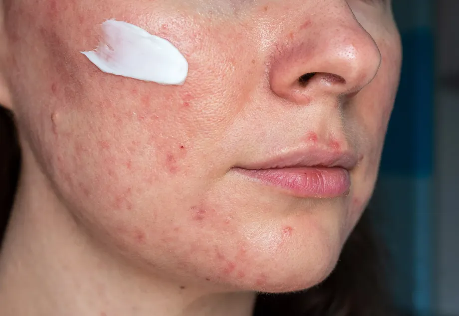 最強のニキビ治療法は?内服薬vs外用薬の効果比較とイソトレチノイン
