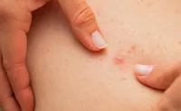 毛包炎とは？ニキビとの違い・症状・治療法から再発予防まで徹底解説