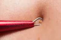 ニキビ圧出の正しい方法とタイミング|跡を防ぐケアとイソトレチノイン治療