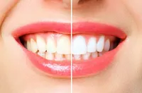 ホワイトニングは歯に悪い？｜効果・副作用・持続期間と正しい方法 