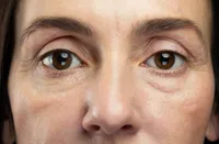 目の下のたるみは老化サイン?NMNで内側から始める若返り習慣