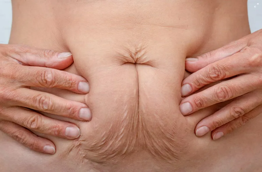 ダイエットで肌がやつれる理由とは?